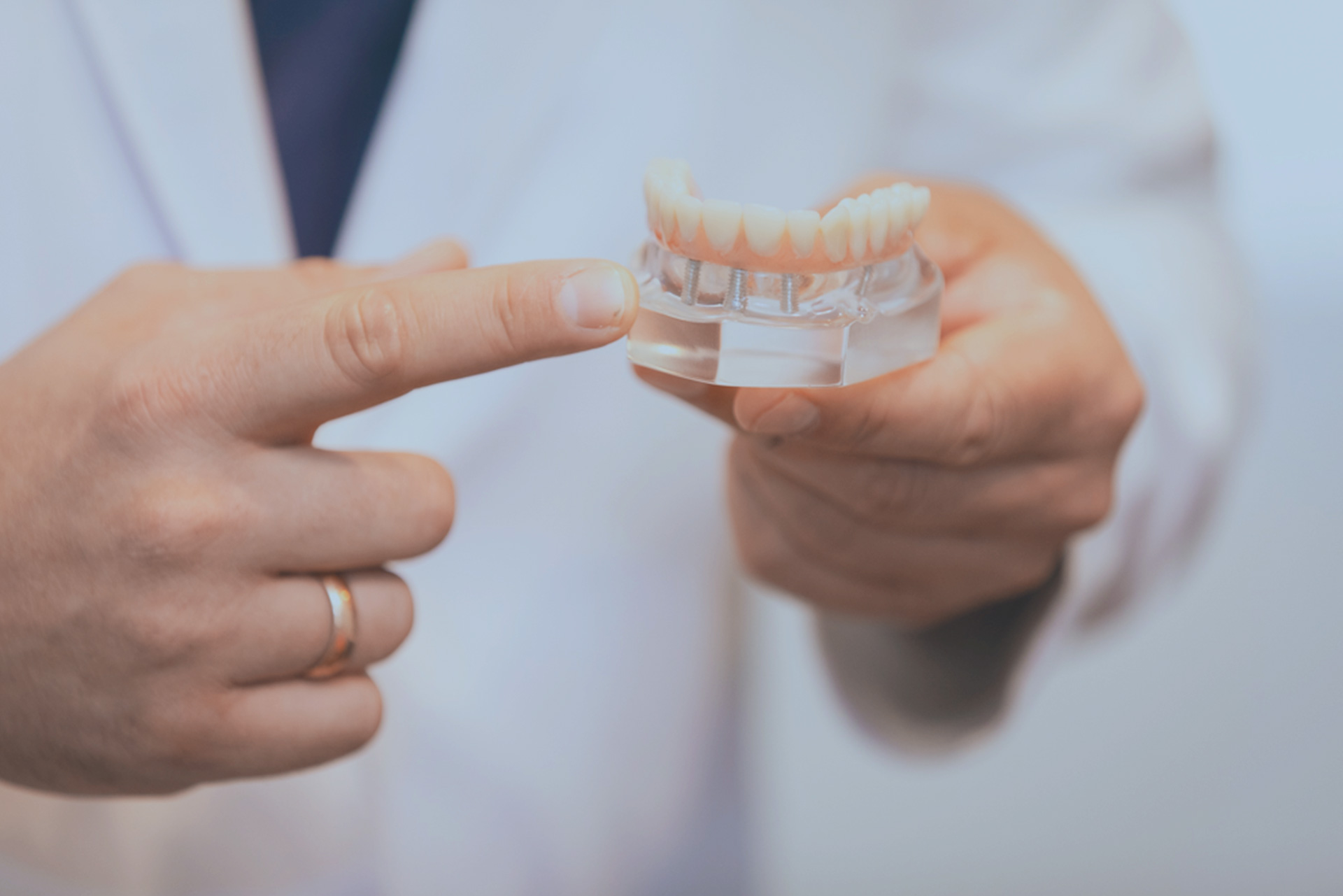 dental implant model.