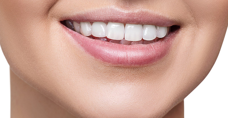 a patient smiling with a full set of dental implants creating an arch of teeth