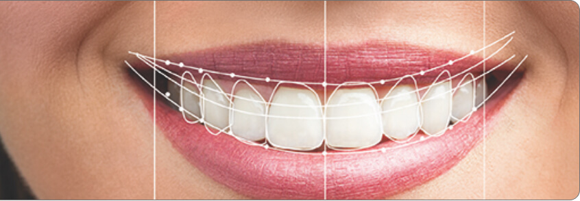 a software showing digital smile designs ability to capture the shape of teeth