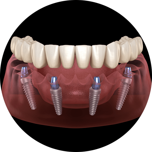 all on 4 dental implant model showing how the implants are placed for a full arch of teeth