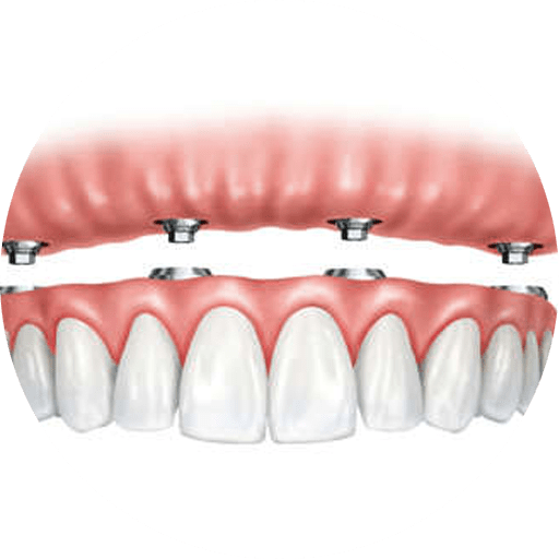 a snap on set of dentures supported by implants