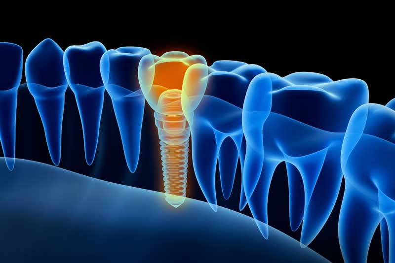 a digital graphic of a placed dental implant