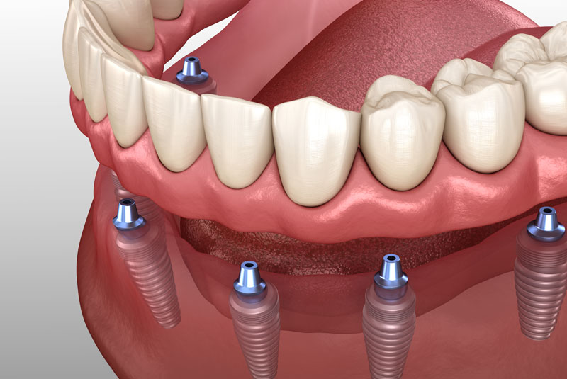 Implant Supported Denture