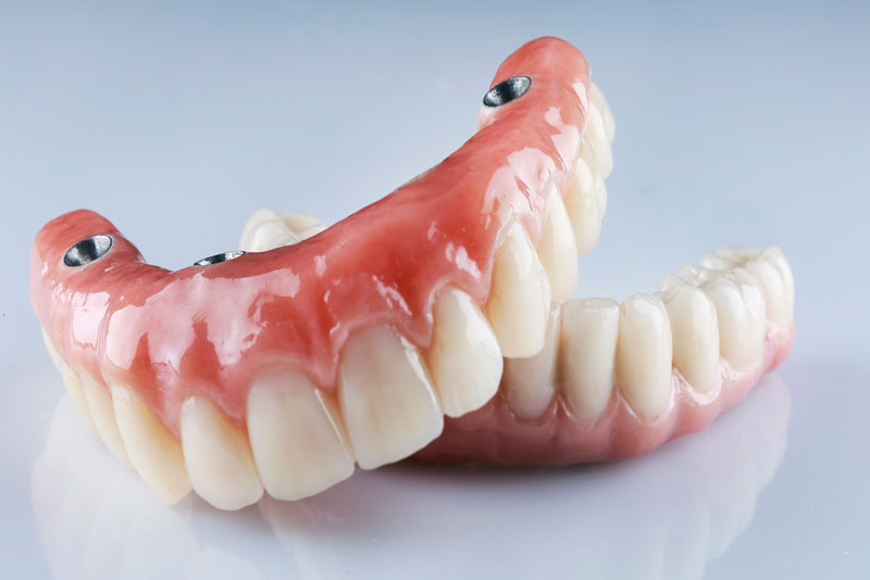 a full mouth dental implants model.