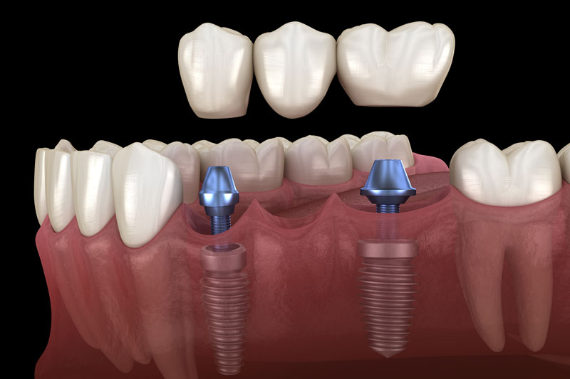 dental implant model illustration with a crown bridge above it about to be placed