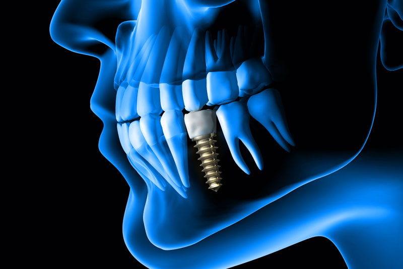 xray visualizing a dental implant that is placed in the premolar