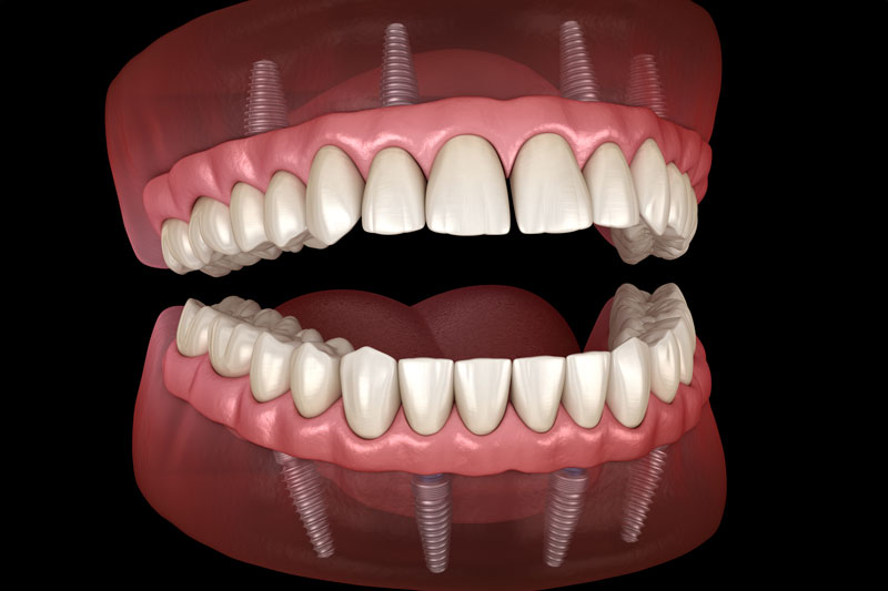 a full arch of dental implants showing how its placed into the jaw