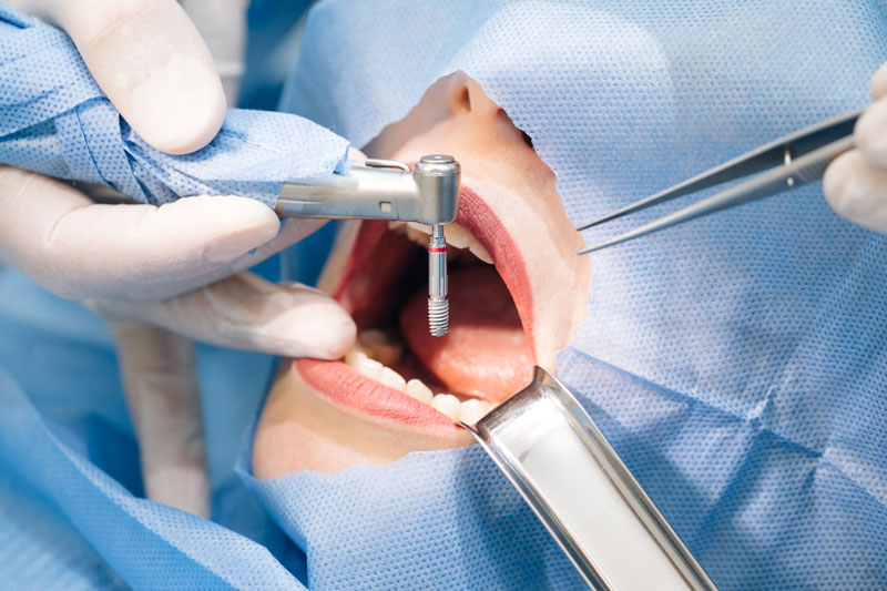 a woman getting dental implants done on her mouth