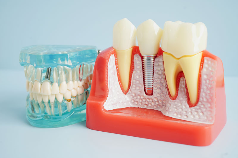 a cut away of the jaw with an implant showing and a full arch of teeth to the left