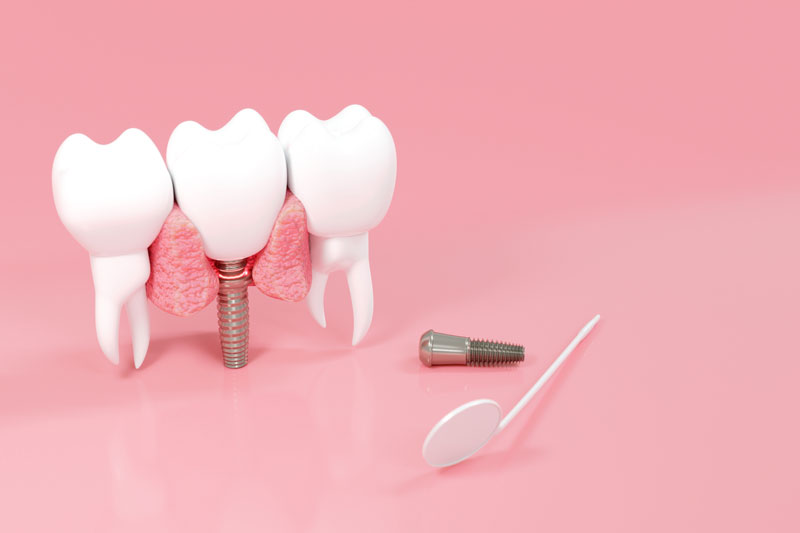 an implant being shown with 2 adjacent teeth and a mirror