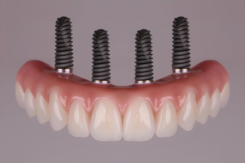 a full arch of teeth with 4 implants attached to the teeth