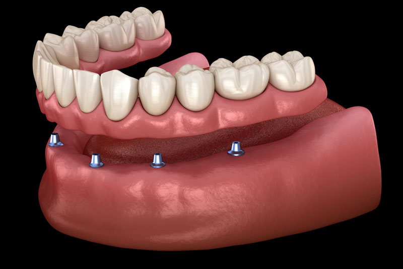 all on 4 denture implants with a full arch of teeth on top of the implants
