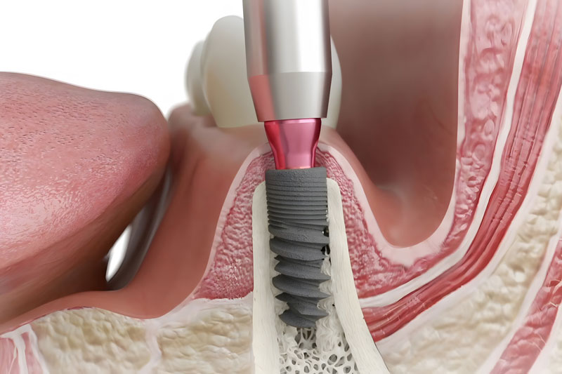 a single dental implant with the jawbone structure shown and gum line