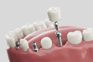 3 single dental implants with crowns on top of each of them