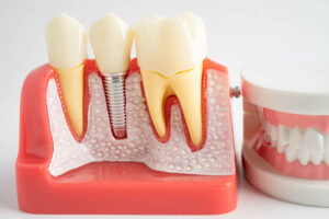 a dental implant with a full arch of teeth next to it