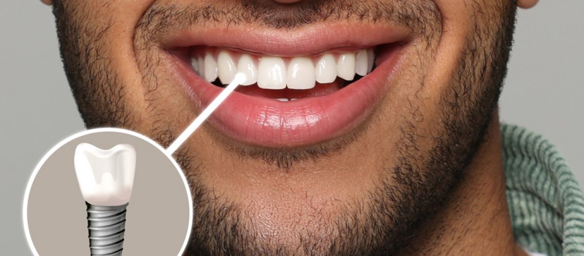 Happy man with perfect teeth smiling on grey background, closeup. Illustration of dental implant