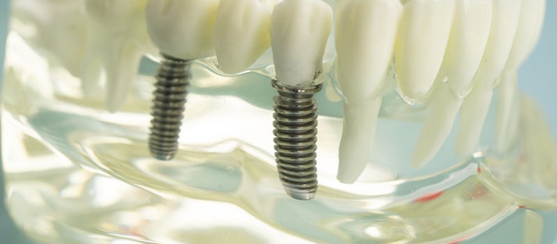 2 single dental implants with a clear jaw to hold them onto it