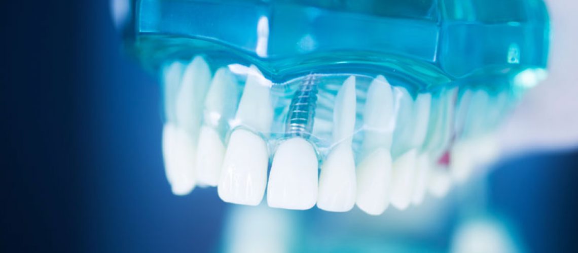 Dental tooth implant titanium prosthetic dentists’ model, image is blurry from being taken up-close. Dental mouth and jaw model with dental implants