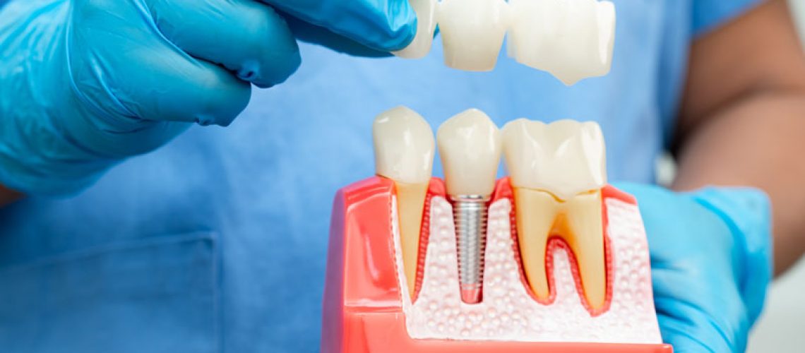 Dentist holding a dental implants model with blue gloves on in a dental office