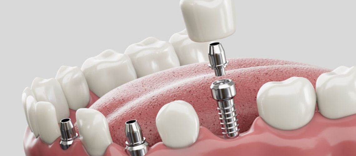 3 single dental implants with crowns on top of each of them