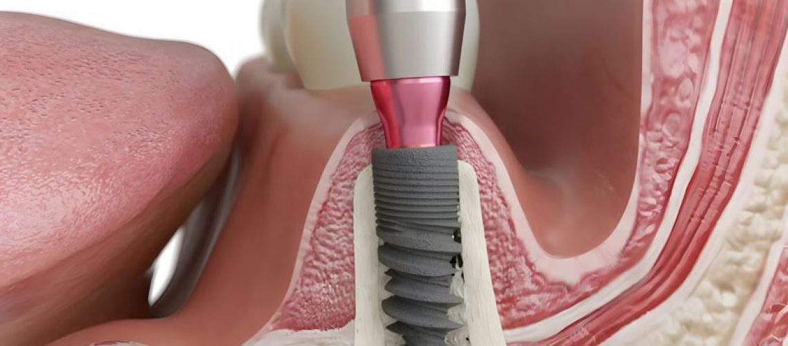 a single dental implant with the jawbone structure shown and gum line
