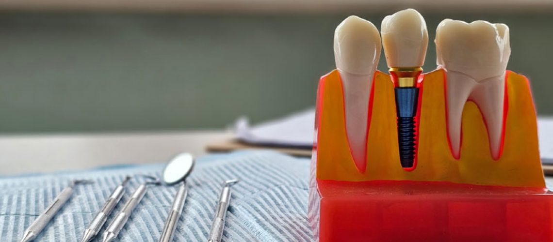 Dental implant, artificial tooth roots into jaw, root canal of dental treatment, gum disease, teeth model for dentist