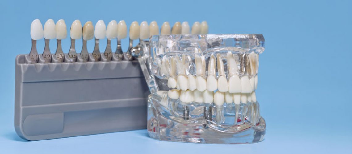 Close-up of a transparent dental implant model with artificial teeth, showcasing metal implants, with a tooth shade guide in the background.