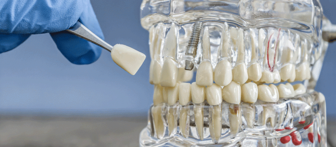 Explore tooth replacement options, including dental implants, and restore your smile with expert care and personalized solutions.