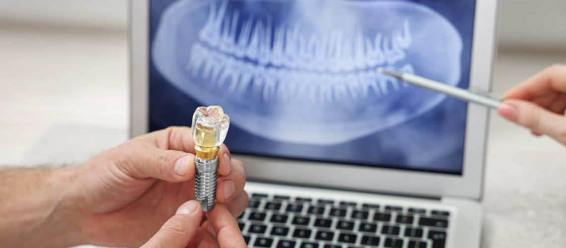 A dental professional holds a dental implant model while pointing at a dental X-ray on a laptop screen. This image emphasizes the precision and planning involved in dental implant procedures.