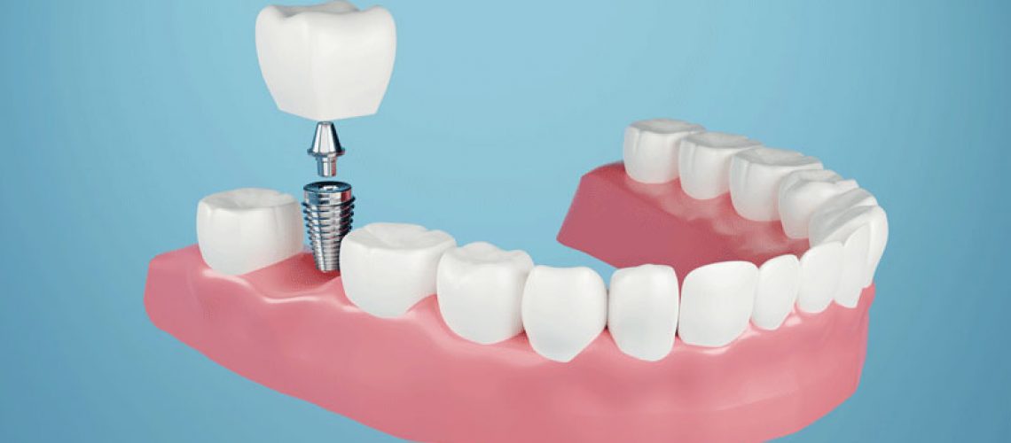 Dental implant, Fixing missing teeth with metal screw, teeth crown treatment 3D rendering