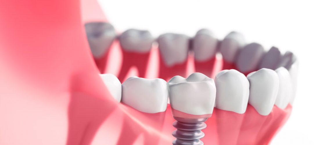 Close-up of a dental implant integrated into the lower jaw, illustrating the implant's placement and its realistic appearance alongside natural teeth.