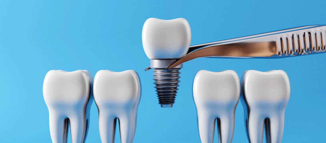 Dental implants and Healthy white teeth, picked up by dental tweezers. Oral health and dental inspection teeth.