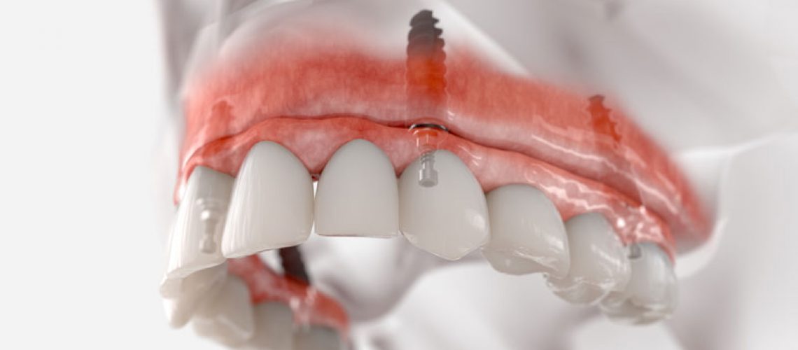 3D illustration of a maxillary fixed restoration with four dental implants, showing how implants support dental prosthetics for a secure and functional fit.