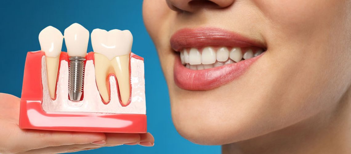 A woman smiles, holding a dental implant model showing the post and crown, emphasizing the natural, restored look and aesthetic benefits.