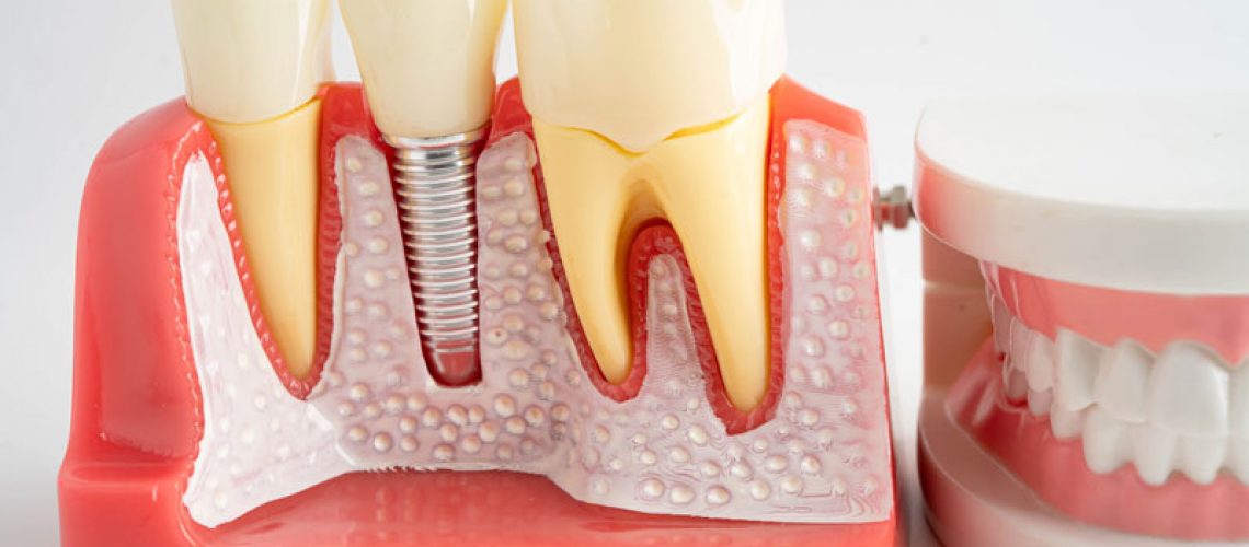 a dental implant with a full arch of teeth next to it