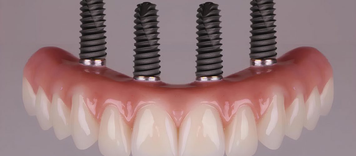 a full arch of teeth with 4 implants attached to the teeth