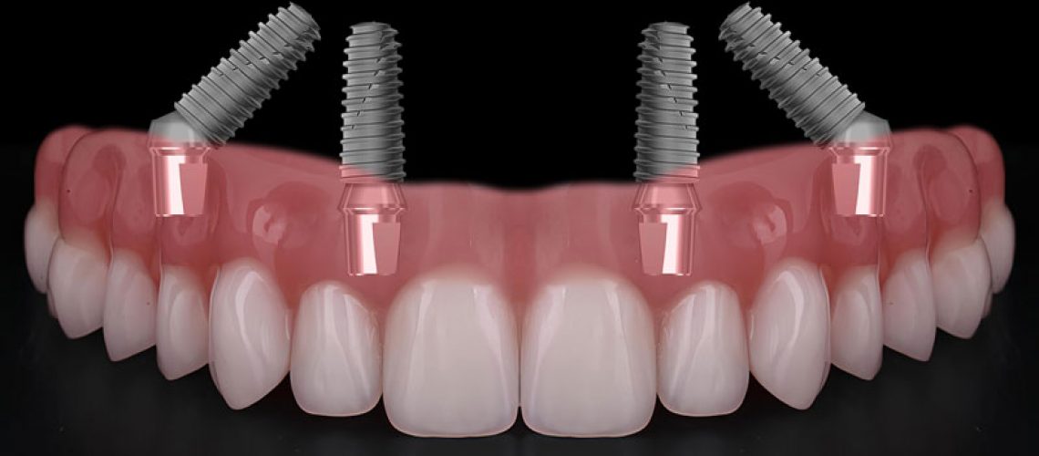 all on 4 dental implants with a full arch of teeth going across it