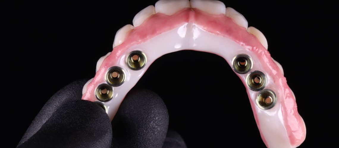 a full arch of teeth with holes for implants to be placed