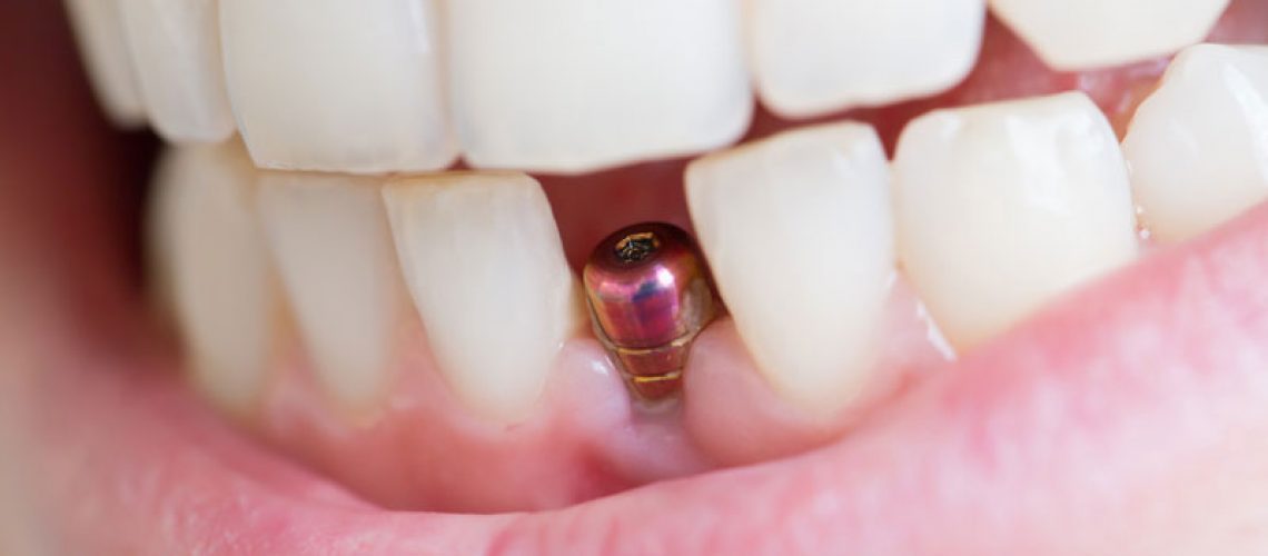 a single dental implant that needs a crown placed on top of it