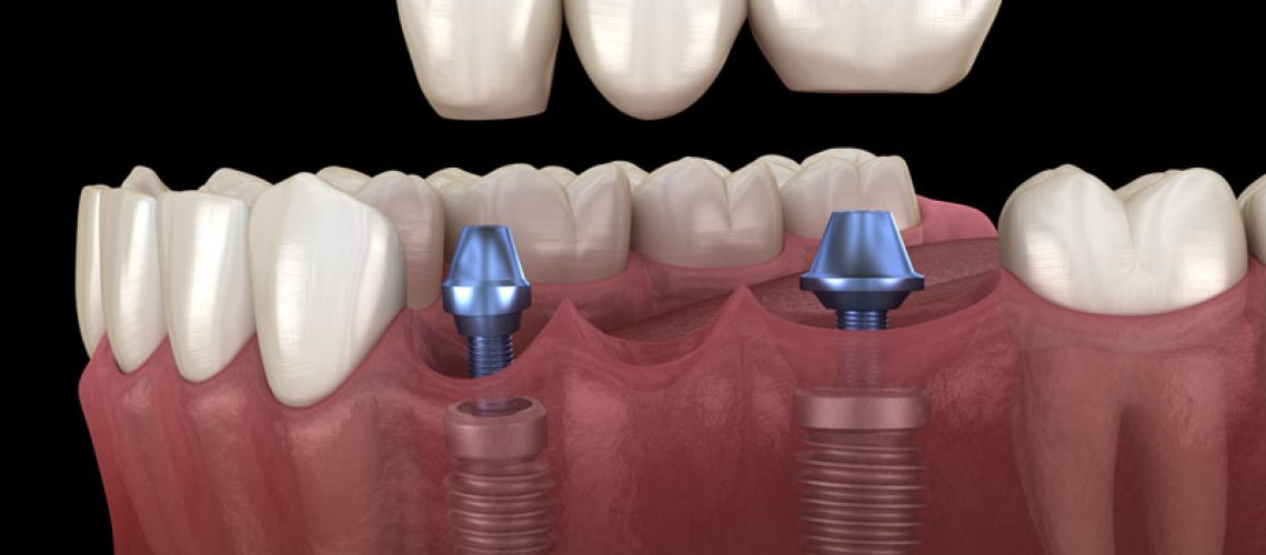 dental implant model illustration with a crown bridge above it about to be placed