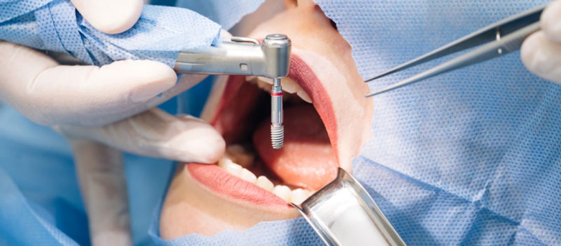 a woman getting dental implants done on her mouth