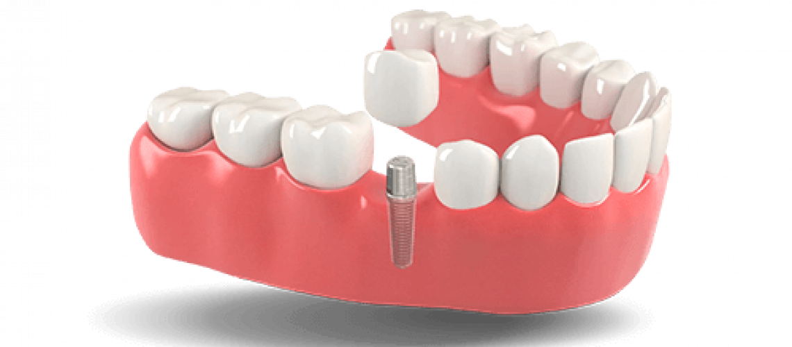 Dental implants model