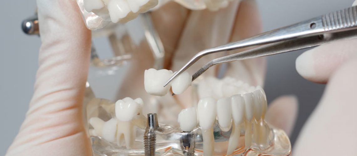 Photo of a doctor holding and working on a clear jaw prosthesis with an implant in it.