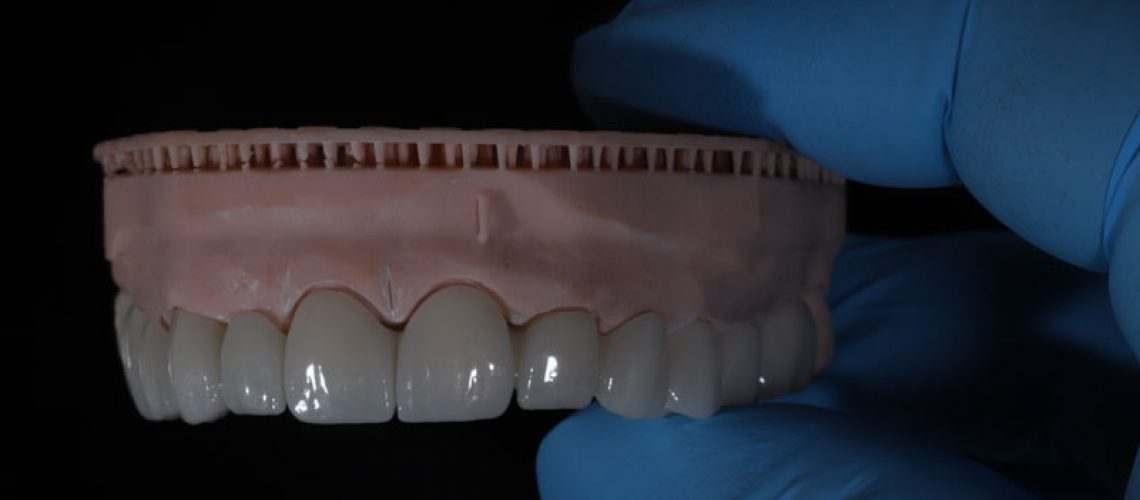 a full arch of teeth being held up by a dentist with a glove on