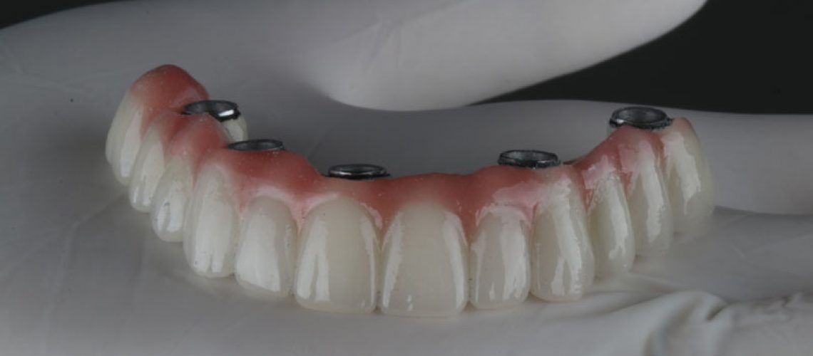 a full arch of dental implants with holes for implants to be placed into the jaw