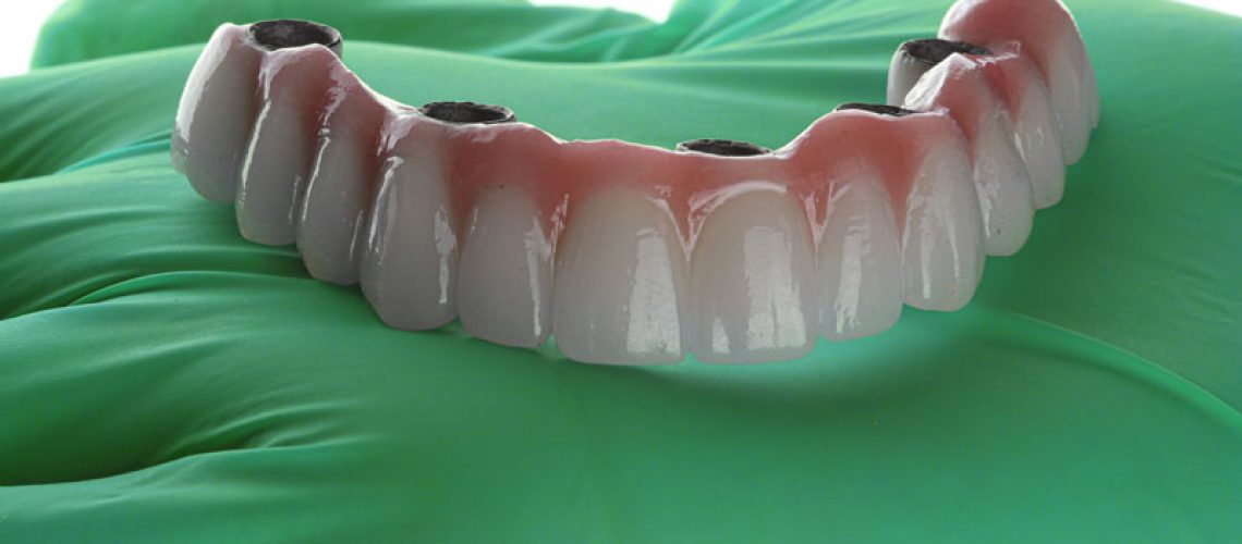 a full arch of teeth with 4 holes for dental implants to be placed