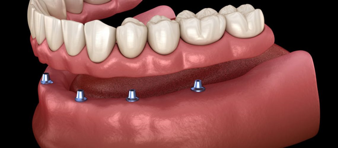 all on 4 denture implants with a full arch of teeth on top of the implants
