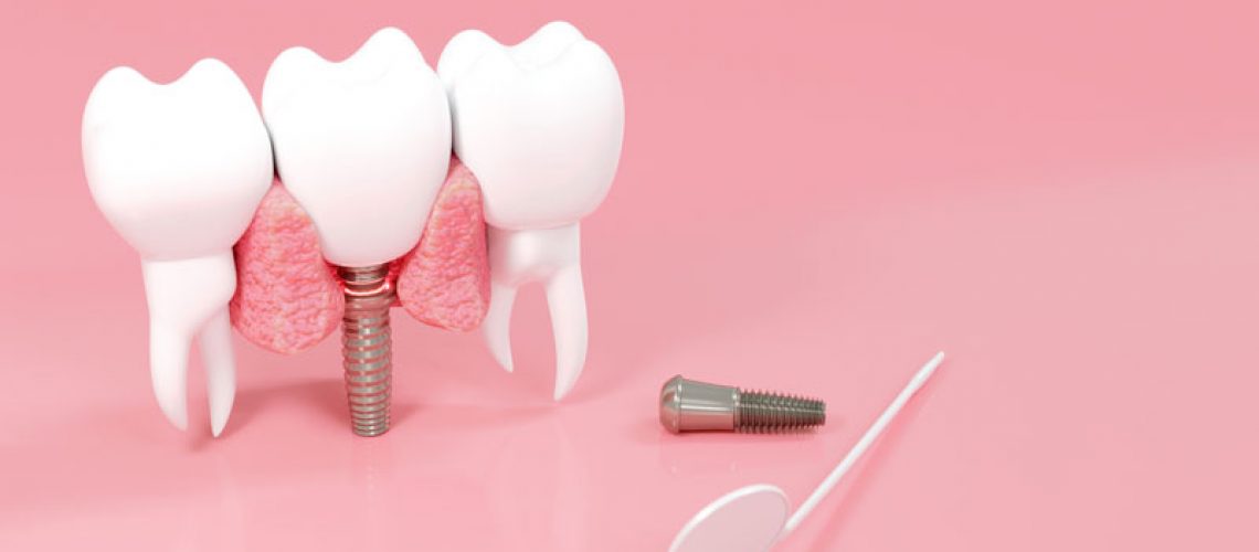 an implant being shown with 2 adjacent teeth and a mirror