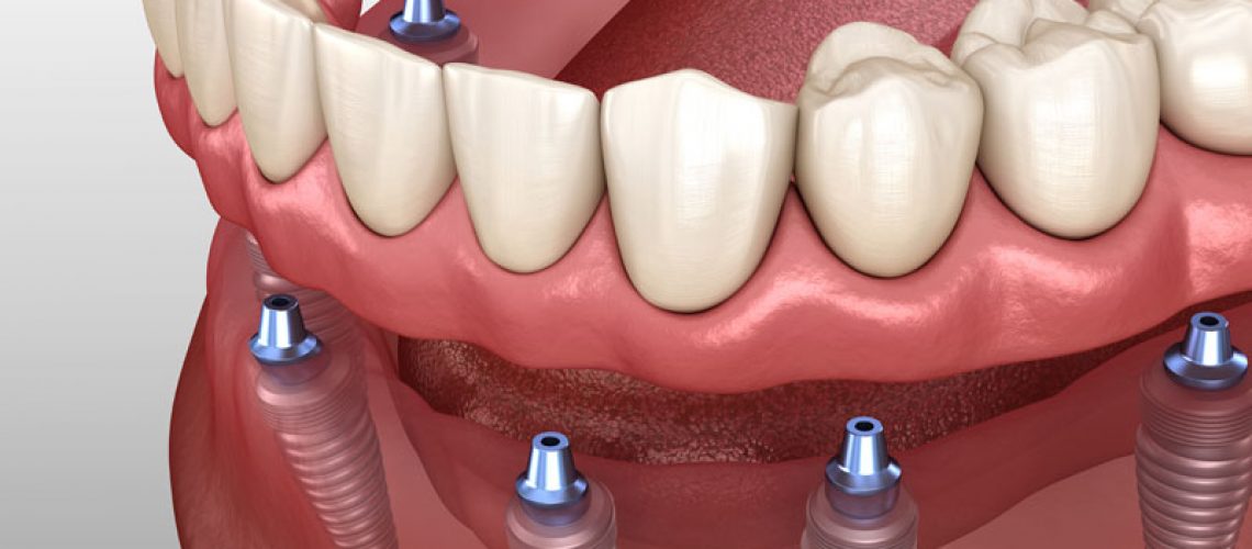 Implant Supported Denture