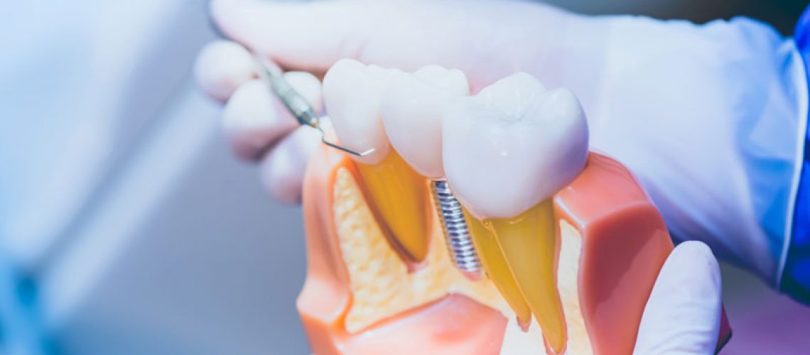 Image of a doctor holding a dental implants model at an angel